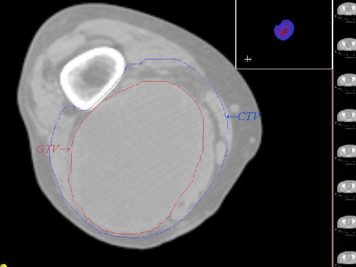 Rtog Rni Atlast RTOG Extremity Soft Tissue Sarcoma Atlas RTOG Sarcoma