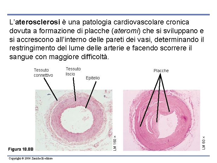 L’aterosclerosi è una patologia cardiovascolare cronica dovuta a formazione di placche (ateromi) che si