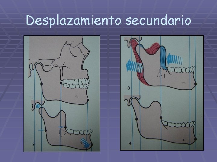 Desplazamiento secundario 