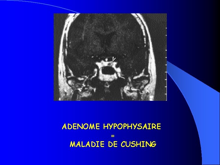 ADENOME HYPOPHYSAIRE = MALADIE DE CUSHING 