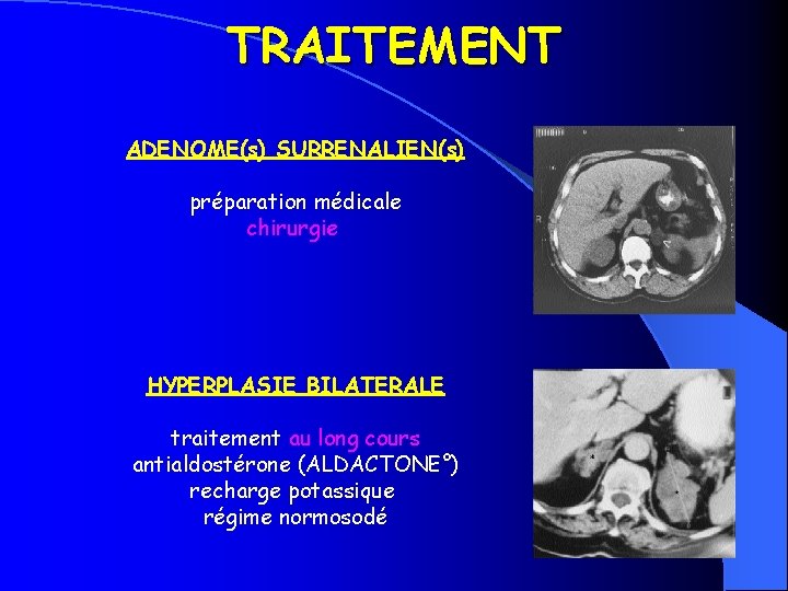TRAITEMENT ADENOME(s) SURRENALIEN(s) préparation médicale chirurgie HYPERPLASIE BILATERALE traitement au long cours antialdostérone (ALDACTONE°)