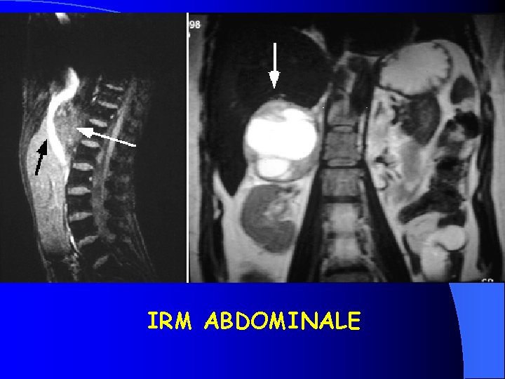 IRM ABDOMINALE 