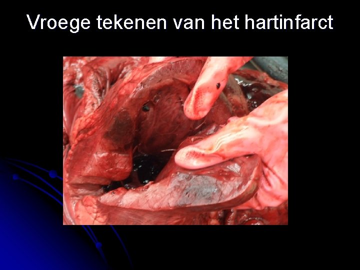 Vroege tekenen van het hartinfarct 