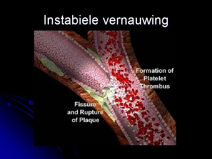 Instabiele vernauwing 