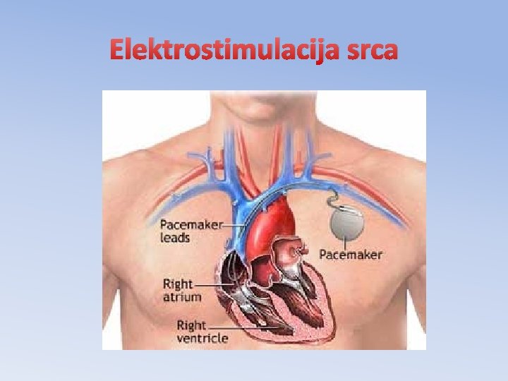 Elektrostimulacija srca 
