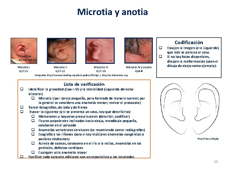 Microtia y anotia q q 2. 7 cm Normal: 3 -4 cm Microtia I