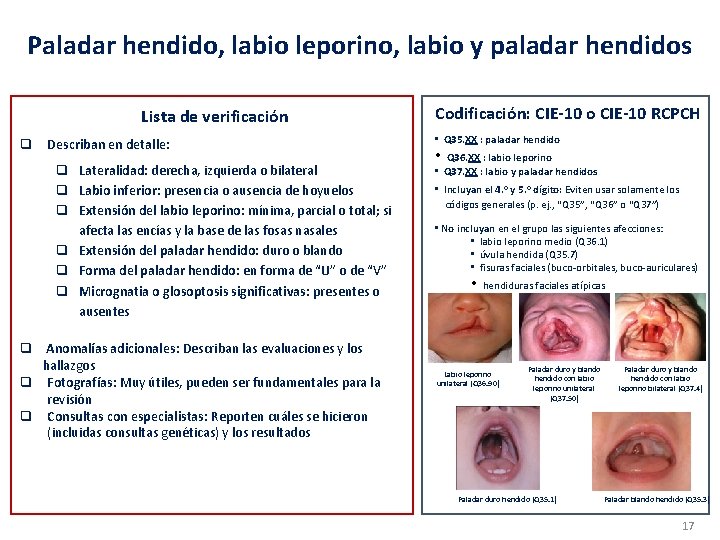 Paladar hendido, labio leporino, labio y paladar hendidos Lista de verificación q Describan en