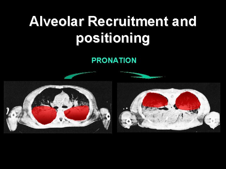 Alveolar Recruitment and positioning PRONATION 