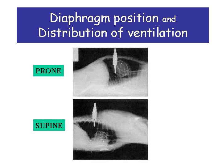 Diaphragm position and Distribution of ventilation PRONE SUPINE 