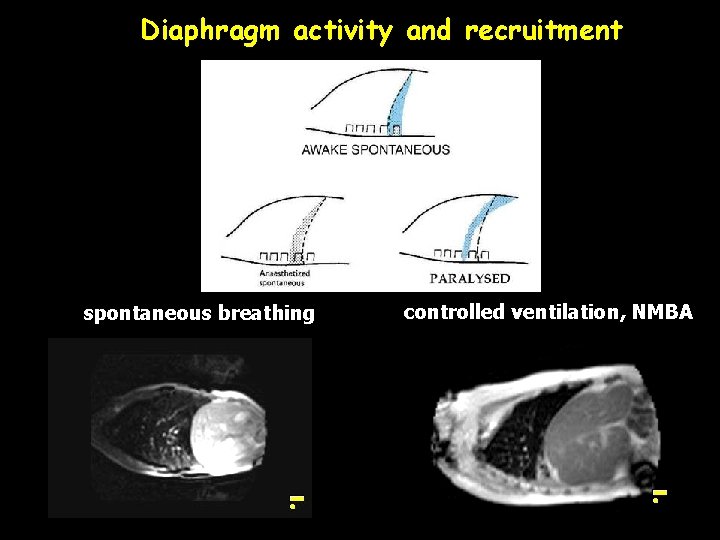 Diaphragm activity and recruitment spontaneous breathing controlled ventilation, NMBA 