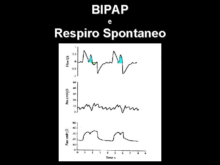 BIPAP e Respiro Spontaneo 