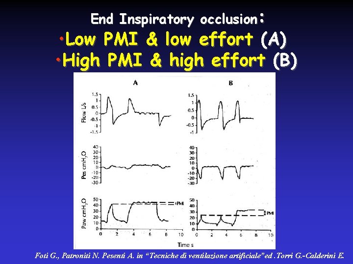 End Inspiratory occlusion: • Low PMI & low effort (A) • High PMI &