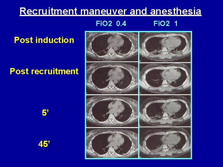 Recruitment maneuver and anesthesia Fi. O 2 0. 4 Post induction Post recruitment 5’