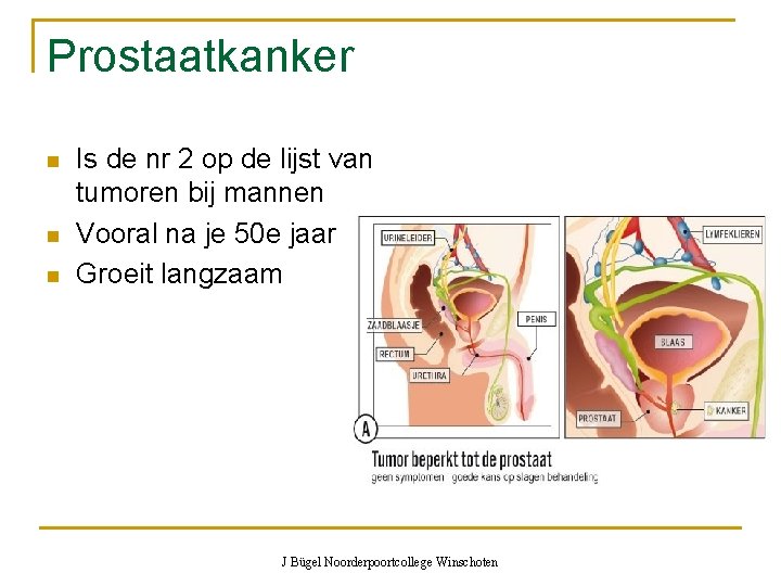 Prostaatkanker n n n Is de nr 2 op de lijst van tumoren bij