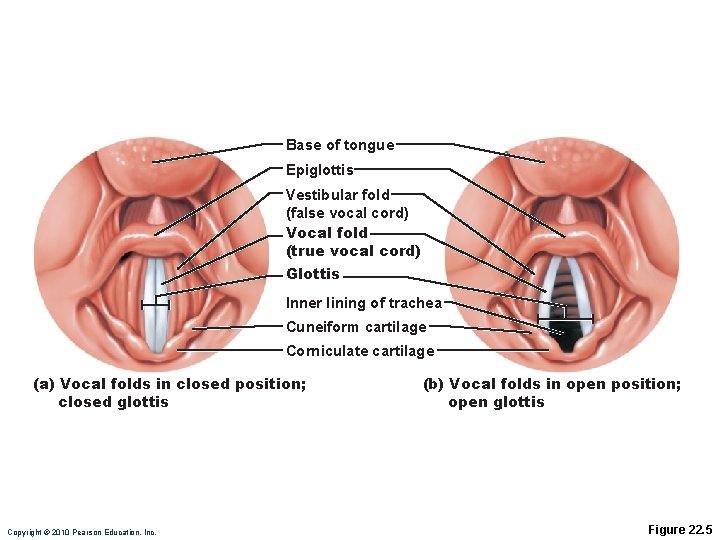 Base of tongue Epiglottis Vestibular fold (false vocal cord) Vocal fold (true vocal cord)