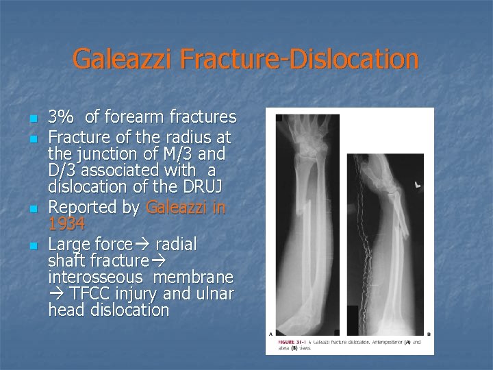 Galeazzi Fracture-Dislocation n n 3% of forearm fractures Fracture of the radius at the