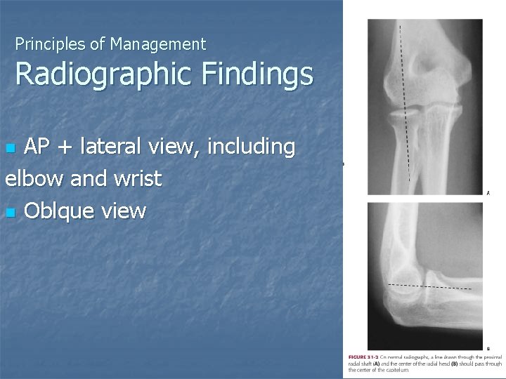 Principles of Management Radiographic Findings AP + lateral view, including elbow and wrist n