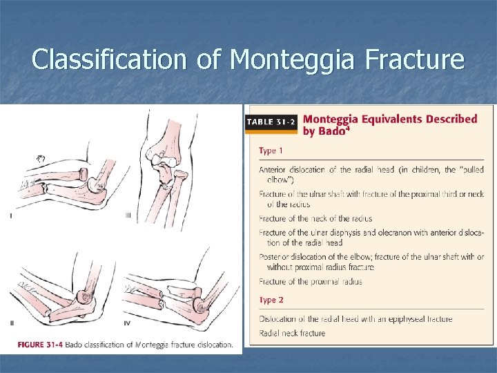 Classification of Monteggia Fracture 15 -30% 59 -79% 