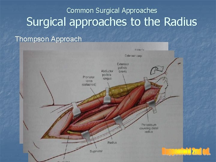 Common Surgical Approaches Surgical approaches to the Radius Thompson Approach 