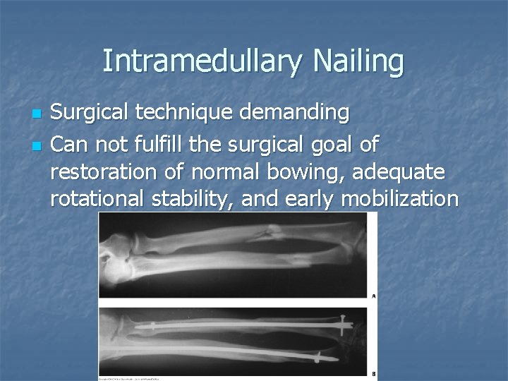 Intramedullary Nailing n n Surgical technique demanding Can not fulfill the surgical goal of