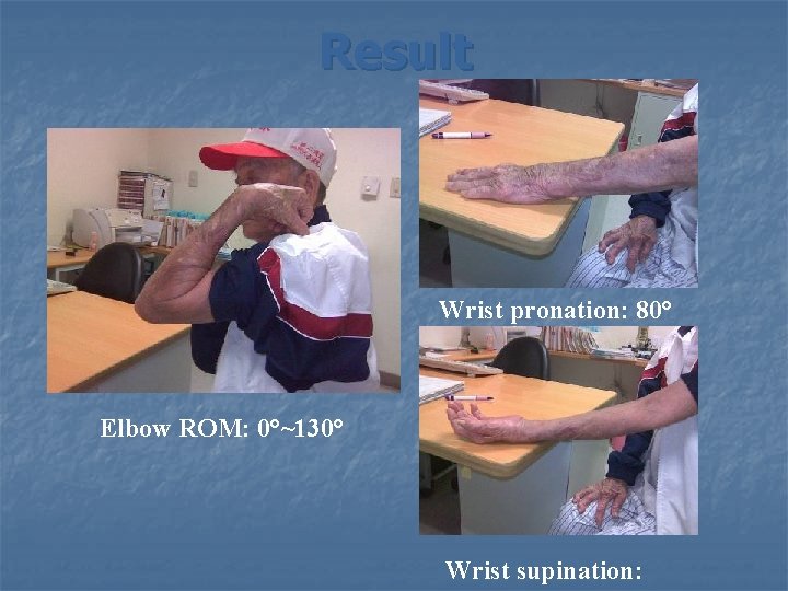 Result Wrist pronation: 80° Elbow ROM: 0°~130° Wrist supination: 