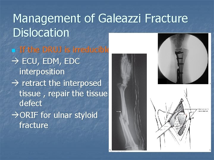 Management of Galeazzi Fracture Dislocation If the DRUJ is irreducible ECU, EDM, EDC interposition