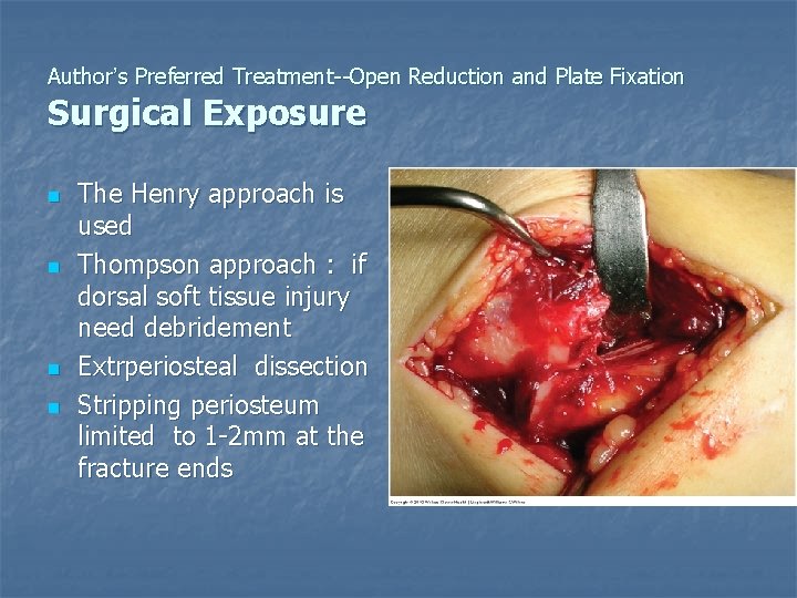 Author’s Preferred Treatment--Open Reduction and Plate Fixation Surgical Exposure n n The Henry approach
