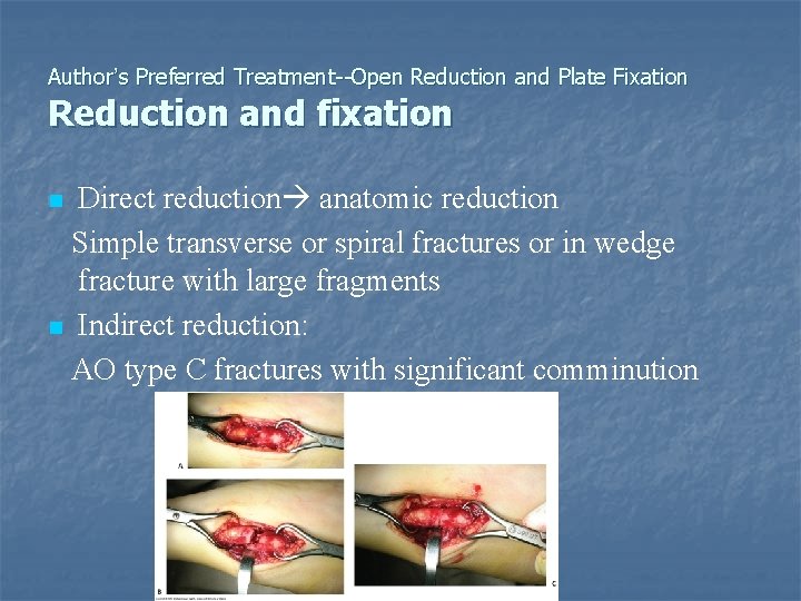 Author’s Preferred Treatment--Open Reduction and Plate Fixation Reduction and fixation Direct reduction anatomic reduction