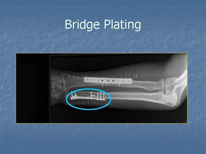 Bridge Plating 