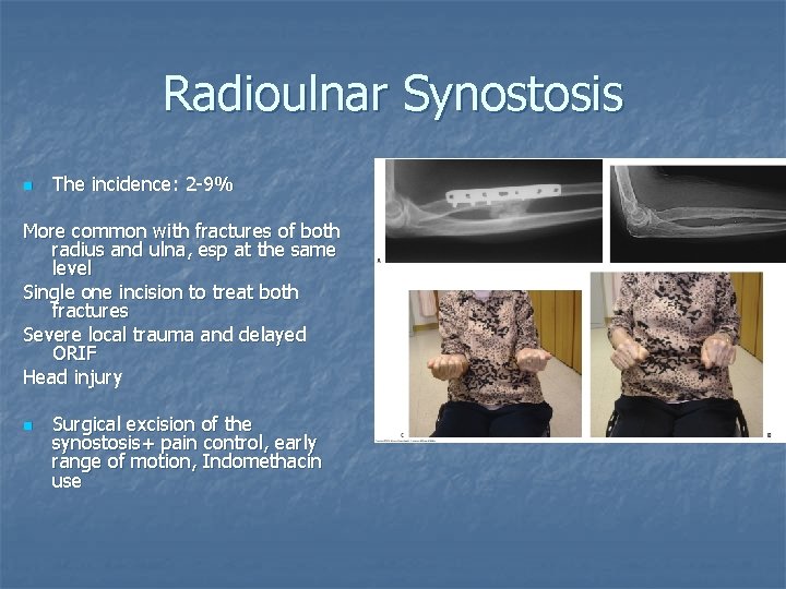 Radioulnar Synostosis n The incidence: 2 -9% More common with fractures of both radius