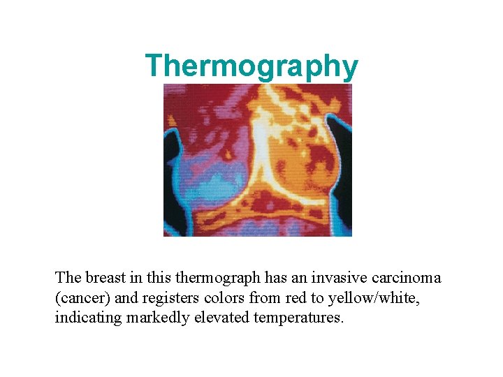 Thermography The breast in this thermograph has an invasive carcinoma (cancer) and registers colors Thermography The breast in this thermograph has an invasive carcinoma (cancer) and registers colors