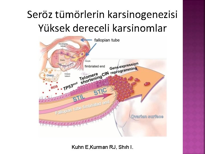 Seröz tümörlerin karsinogenezisi Yüksek dereceli karsinomlar Kuhn E, Kurman RJ, Shıh I. 