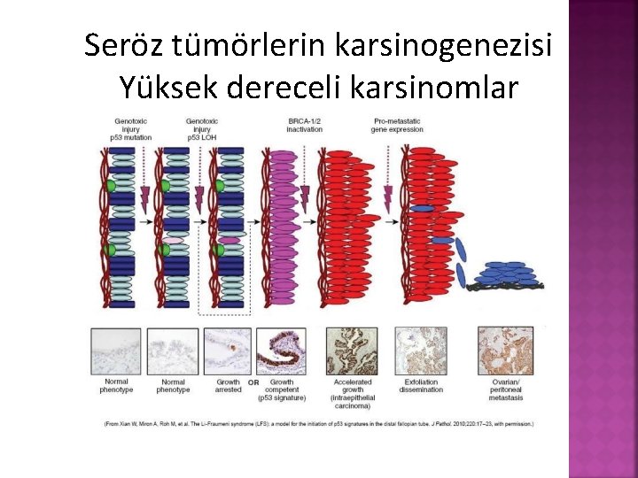 Seröz tümörlerin karsinogenezisi Yüksek dereceli karsinomlar 