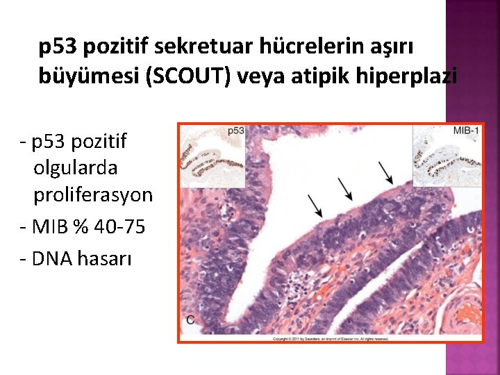 p 53 pozitif sekretuar hücrelerin aşırı büyümesi (SCOUT) veya atipik hiperplazi - p 53