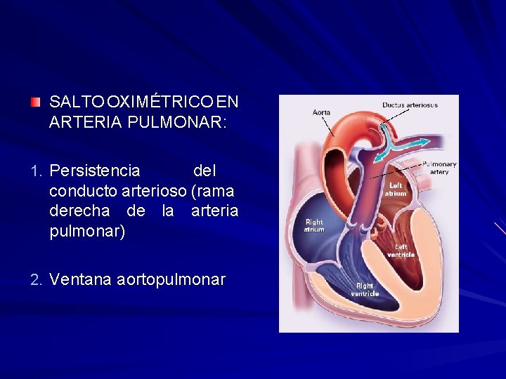 SALTO OXIMÉTRICO EN ARTERIA PULMONAR: 1. Persistencia del conducto arterioso (rama derecha de la
