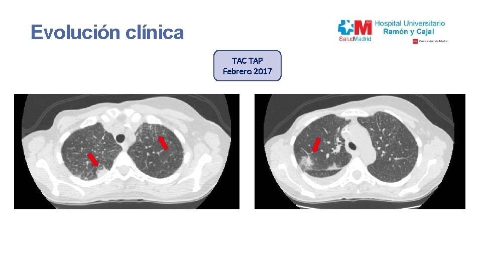 Evolución clínica TAC TAP Febrero 2017 