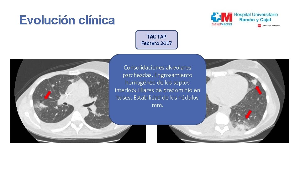 Evolución clínica TAC TAP Febrero 2017 Consolidaciones alveolares parcheadas. Engrosamiento Extensa afectación parenquimatosa homogéneo