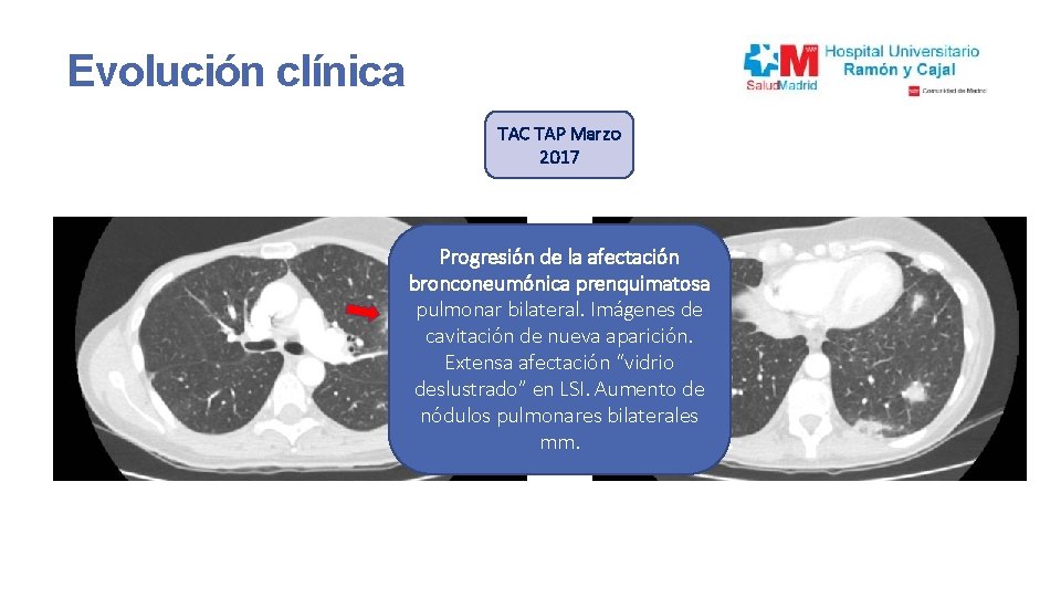 Evolución clínica TAC TAP Marzo 2017 Progresión de la afectación bronconeumónica prenquimatosa pulmonar bilateral.
