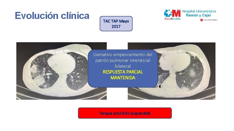 Evolución clínica TAC TAP Mayo 2017 Llamativo empeoramiento del patrón pulmonar intersticial bilateral RESPUESTA