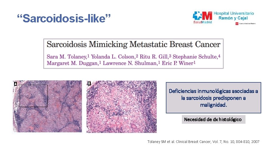 “Sarcoidosis-like” 3 Deficiencias casos de inmunológicas Ca mama localizado cona asociadas afectación pulmonarpredisponen y