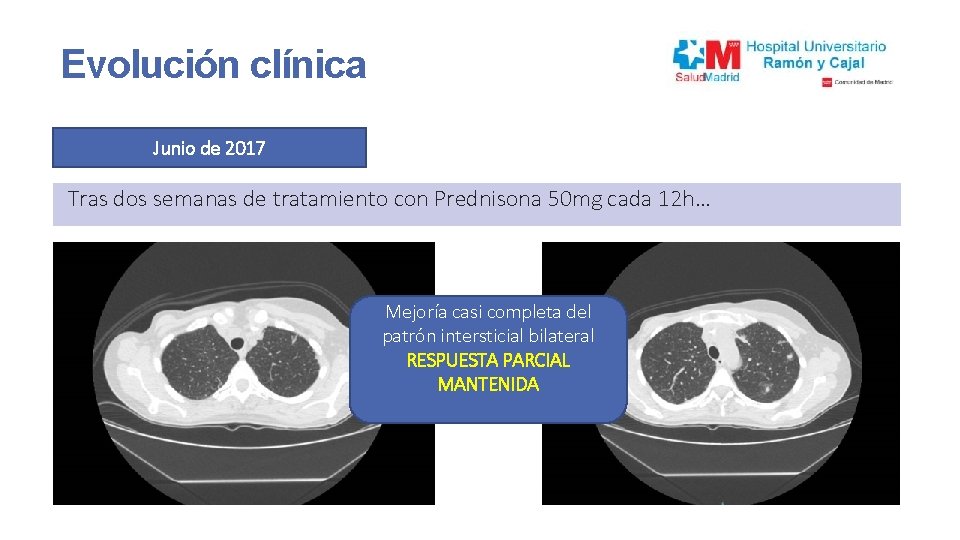 Evolución clínica Junio de 2017 Tras dos semanas de tratamiento con Prednisona 50 mg