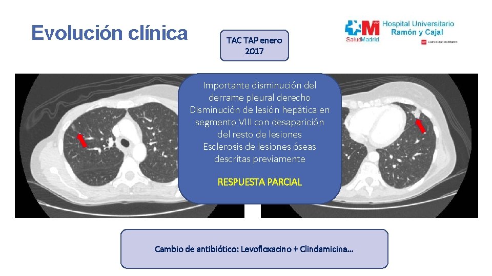 Evolución clínica TAC TAP enero 2017 Importante disminución del derrame pleural derecho Mejoría afectación