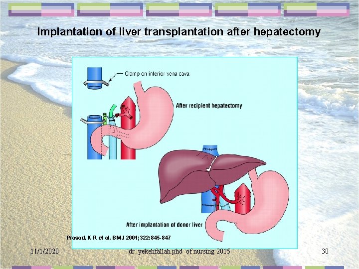 Implantation of liver transplantation after hepatectomy Prasad, K R et al. BMJ 2001; 322: