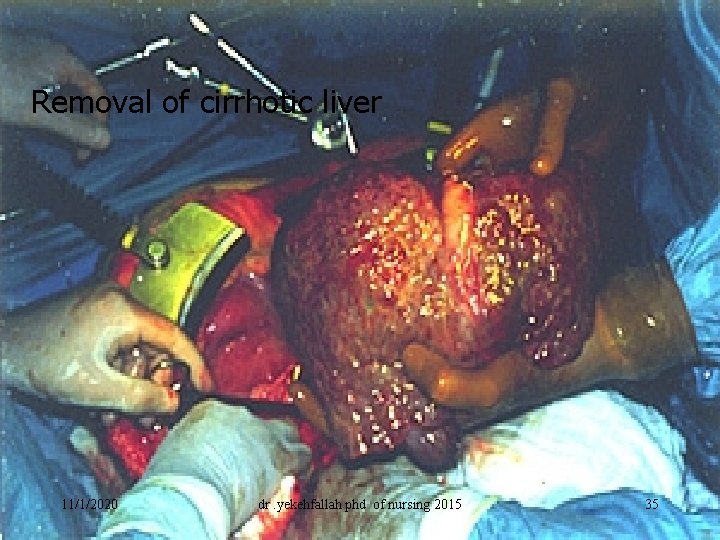 Removal of cirrhotic liver 11/1/2020 dr. yekehfallah phd of nursing 2015 35 