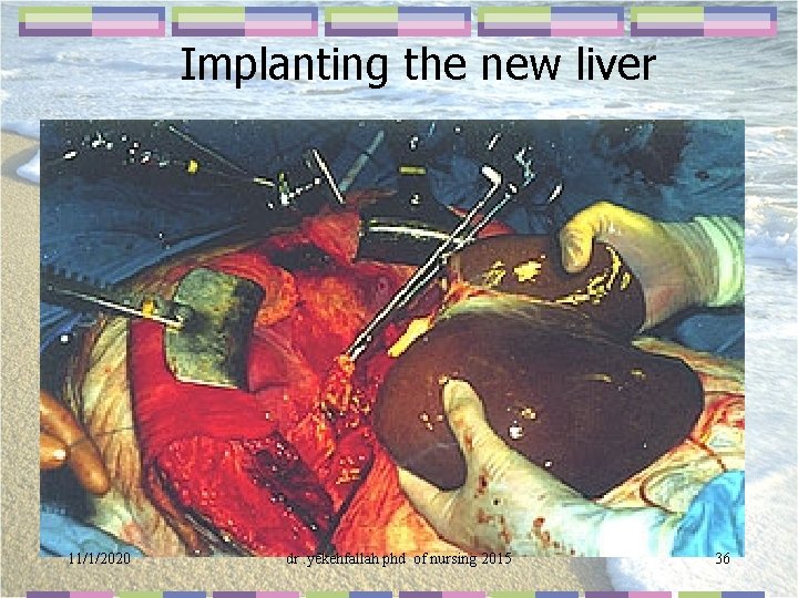 Implanting the new liver 11/1/2020 dr. yekehfallah phd of nursing 2015 36 