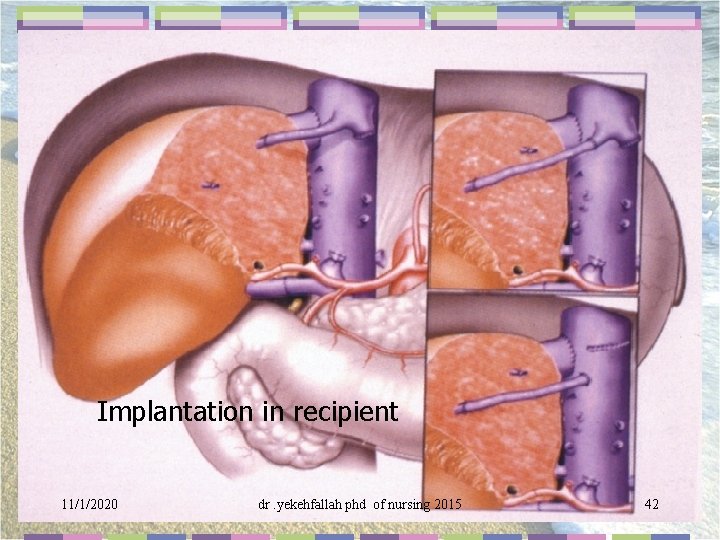 Implantation in recipient 11/1/2020 dr. yekehfallah phd of nursing 2015 42 