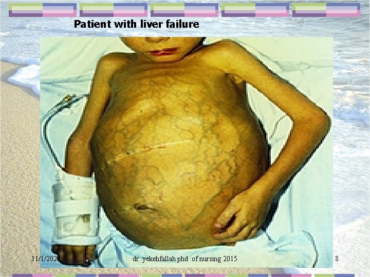 Patient with liver failure 11/1/2020 dr. yekehfallah phd of nursing 2015 8 