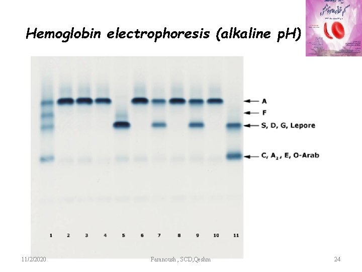 Hemoglobin electrophoresis (alkaline p. H) 11/2/2020 Faranoush , SCD, Qeshm 24 
