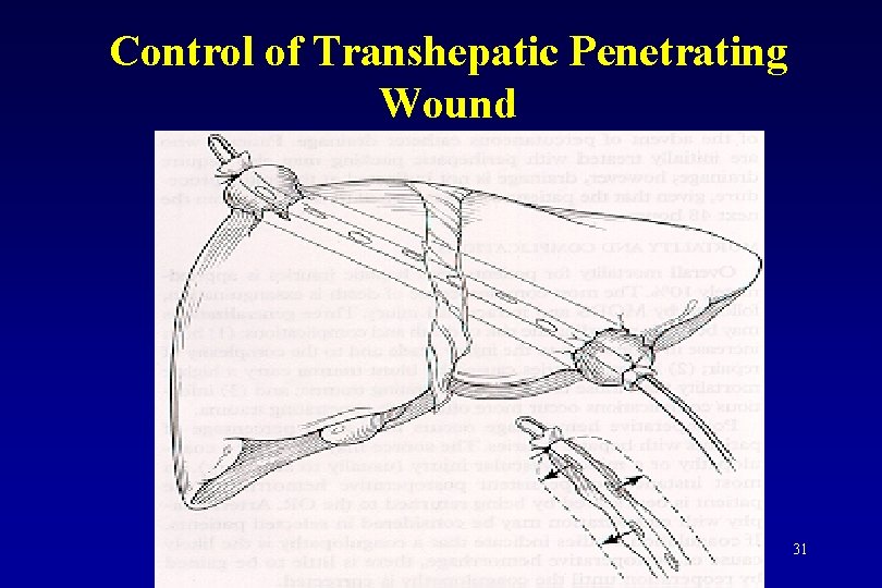 Control of Transhepatic Penetrating Wound 31 