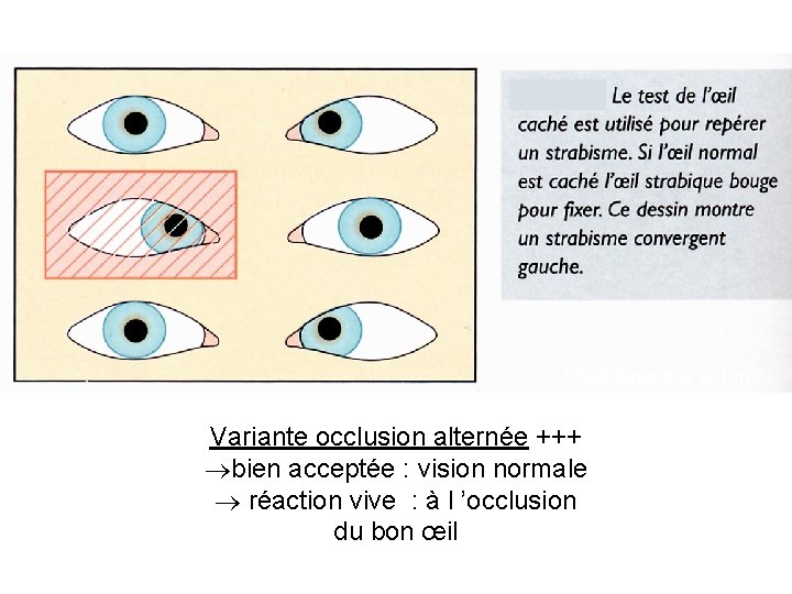 Objet lumineux à 1 m Variante occlusion alternée +++ bien acceptée : vision normale